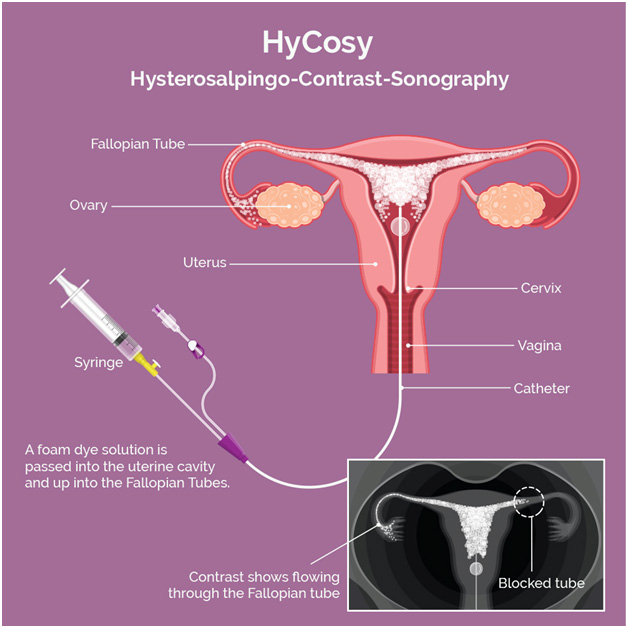 Hysterosalpingogram