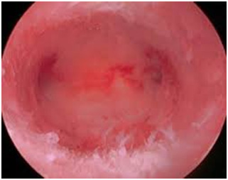 Hysteroscopy